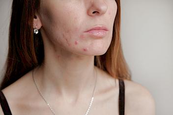 We can help with acne